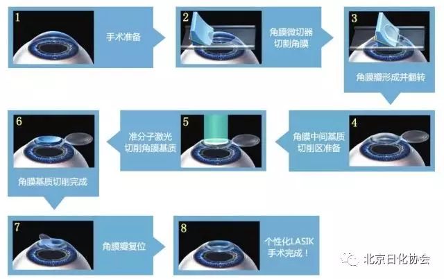 最新近视眼手术方式，时代进步引领视觉革新之路
